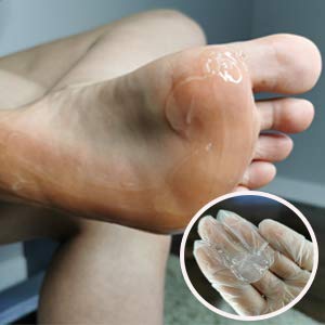 8oz Callus Remover gel for feet for a professional pedicure. Better results than, foot file, pumice stone, foot scrubber, foot buckets & callus shaver. Rid ugly callouses from feet in minutes!