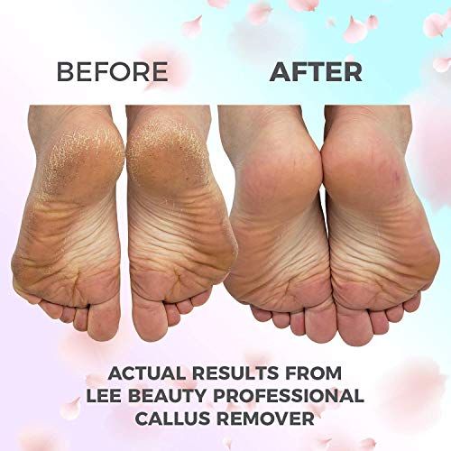 8oz Callus Remover gel for feet for a professional pedicure. Better results than, foot file, pumice stone, foot scrubber, foot buckets & callus shaver. Rid ugly callouses from feet in minutes!